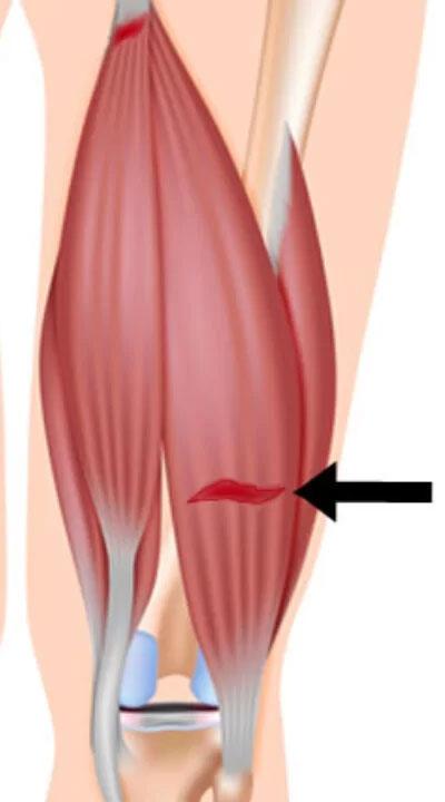 Hamstring muscle injury