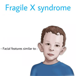 Fragile X Syndrome – Ayurveda Herbal Treatment