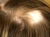 Diagnose Alopecia