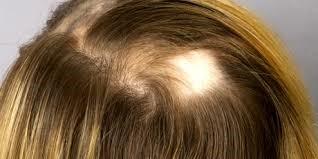 How to Diagnose Alopecia