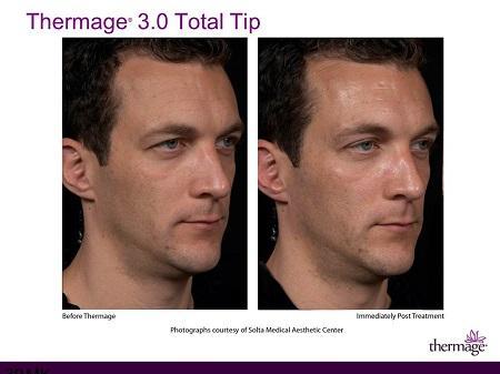 Thermage a single treatment that offers results in Hong Kong Thermage a single treatment that offers results in Hong Kong