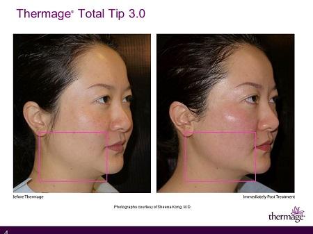 Thermage a single treatment that offers results in Hong Kong