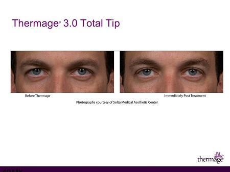 Thermage a single treatment that offers results in Hong Kong Thermage a single treatment that offers results in Hong Kong