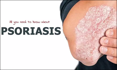 Psoriasis and Its Ayurvedic Treatment with Herbal Remedies