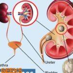 The Signs of Kidney Stones