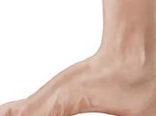 High Arch Feet (Cavus Foot)