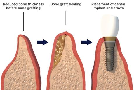 Understanding Bone Grafting for Dental Implants