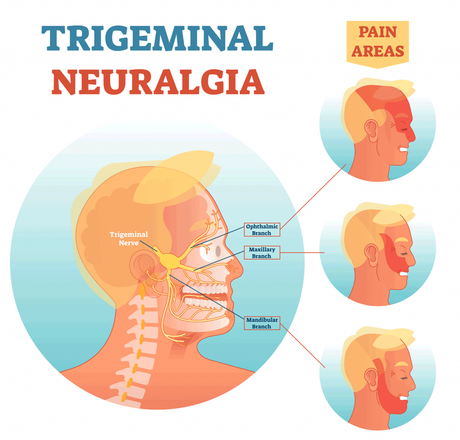Home Remedies for Trigeminal Neuralgia
