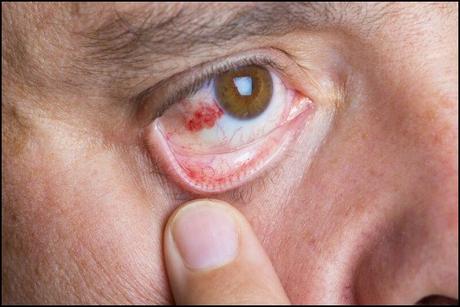 Ayurvedic Treatment for Scleritis with Herbal Remedies