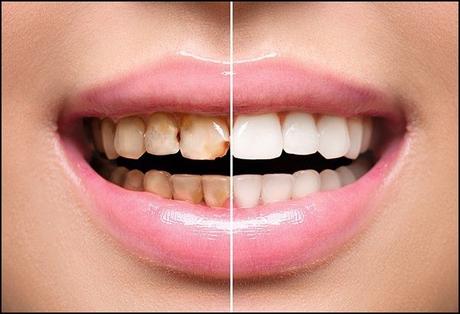 Disadvantage of Excessive Tooth Scaling and How Ayurveda Can Help