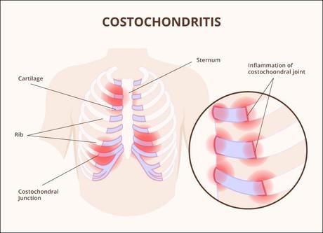 Ayurvedic Treatment For Costochondritis With Herbal Remedies