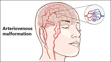 Arteriovenous Malformation Treatment by Herbal Remedies