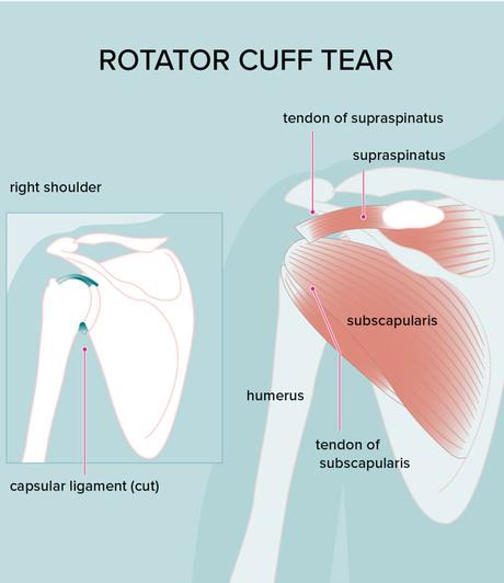 Rotator cuff injury
