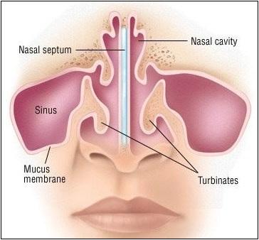 DNS – Deviated Nasal Septum Treatment By Ayurveda