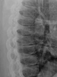 Thoracic Spine X-Ray: Diagnosing Spinal Conditions Diagnosed