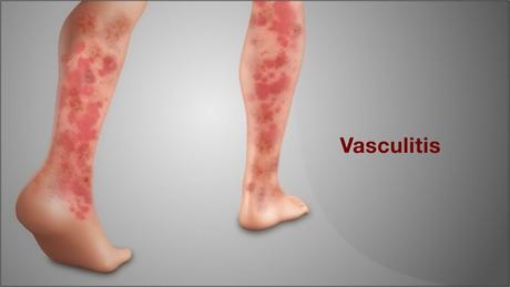 Ayurvedic Treatment of Vasculitis Neuropathy Herbal Remedies