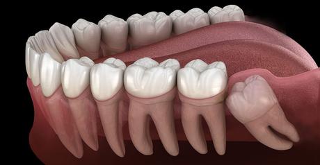 Wisdom Tooth Extraction