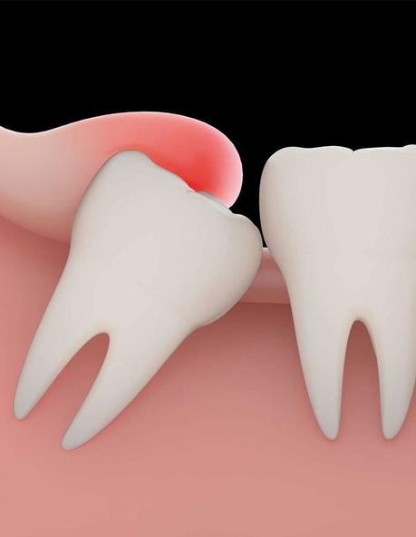 Wisdom Tooth Extraction