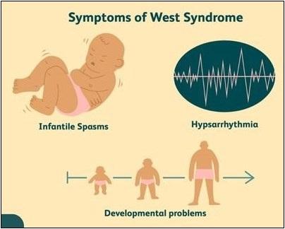 West Syndrome Causes And Treatment With Ayurveda