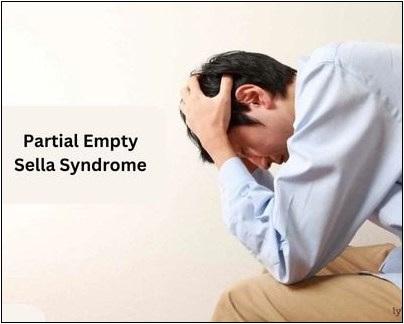 Partial Empty Sella Syndrome Treatment In Ayurveda