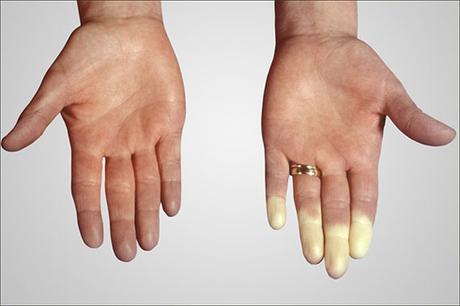Alterative Treatment of Scleroderma-  Polymyositis Overlap Syndrome