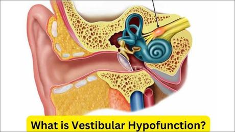 Vestibular Hypofunction Its Treatment with Herbal Remedies