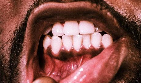 black gums treatment