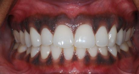 Black Gums Treatment