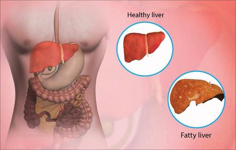 Yakrit Plihantak Churna for Fatty Liver & Other Liver Disease