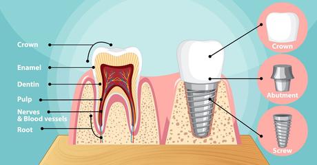 What Can I Eat After Dental Implant Surgery