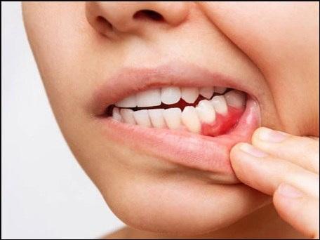 What Is Gum Recession? How Ayurveda Can Help?