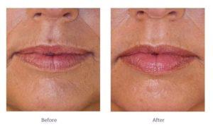 Juvederm Lip Fillers Before and After – Fillers for lip lines