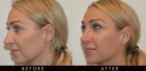 Cheek Filler Before and After: A New Look You’ll Love