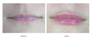 Lip Fillers Before and After Thin Lips
