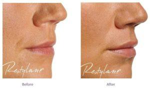 Lip filler applied with Restylane® hyaluronic acid fillers: