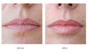 Subtle Lip Filler Before and After