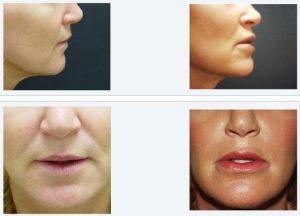 Cheek Filler Before and After: A New Look You’ll Love