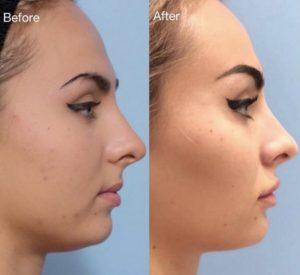 Cheek Filler Before and After: A New Look You’ll Love