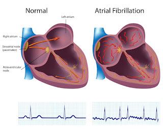 During Atrial Fibrillation, The Top Chambers Of The Heart Beat Chaotically And Irregularly, Goes Out Of Rhythm With The Bottom Chambers During Atrial Fibrillation, The Top Chambers Of The Heart Beat Chaotically And Irregularly, Goes Out Of Rhythm With The Bottom Chambers