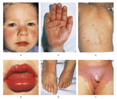 Kawasaki disease: Symptoms, causes, diagnosis, treatment, and scientific research