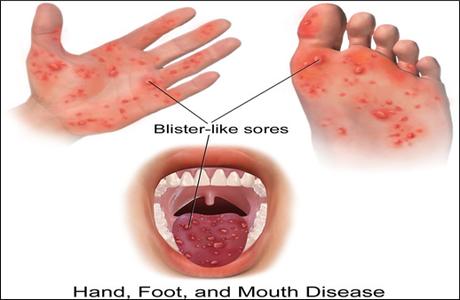 Hand, Mouth & Foot Disease And Its Ayurvedic Treatment