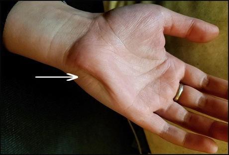 Palmaris Brevis Spasm Syndrome Causes And Treatment By Ayurveda