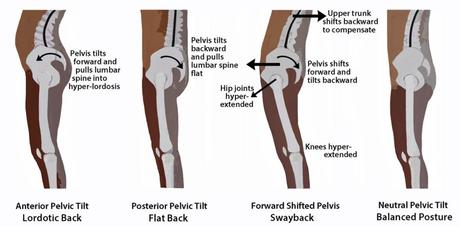 Pelvic Rotation: Causes, Symptoms, Treatment