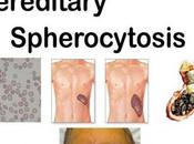 Hereditary Spherocytosis- Causes, Symptoms Ayurvedic Management