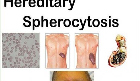 Hereditary Spherocytosis- Causes, Symptoms and its Ayurvedic Management
