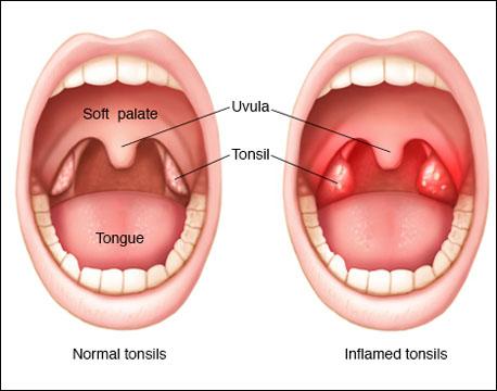 How to Treat Recurrent Tonsillitis Without Surgery?