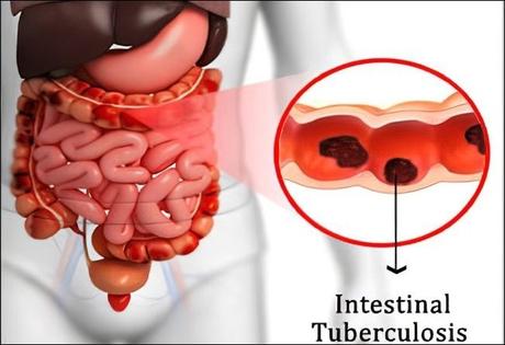 Intestinal Tuberculosis And Its Treatment With Ayurveda