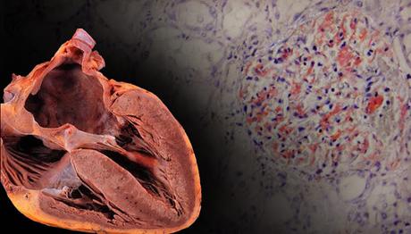 Familial amyloid cardiomyopathy (FAC) Familial amyloid cardiomyopathy (FAC)