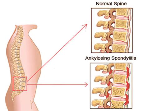 A Chronic Inflammatory Disease Of The Spine, Ankylosing Spondylitis (AS) Occurs In The Axial Spine A Chronic Inflammatory Disease Of The Spine, Ankylosing Spondylitis (AS) Occurs In The Axial Spine