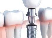 Enticing Ways Improve Your Best Dental Implants Aberdeen Skills